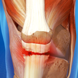 Lesione del Tendine Rotuleo