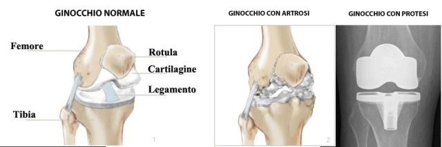 Protesi di ginocchio