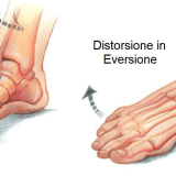 Distorsione di Caviglia