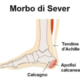 Morbo di Sever